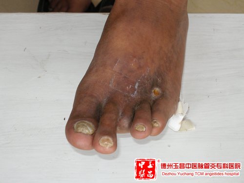 下肢动脉硬化闭塞症的中医病因