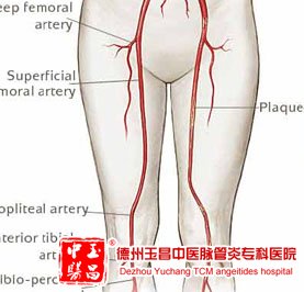 西医支架、搭桥为何不能治愈下肢动脉硬化闭塞