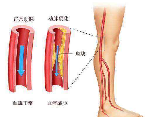 下肢动脉硬化闭塞症的治疗方法有哪些?