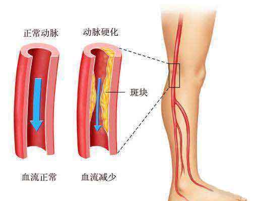 下肢动脉硬化闭塞症的治疗方法有哪些？